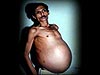 В Индии 36-летний мужчина родил брата-близнеца