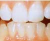 Белизна зубов: методы отбеливания, и существующие минусы.

