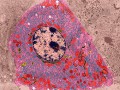 Вирус гепатита С не позволяет клеткам печени погибнуть
