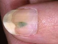 Какие болезни можно определить по ногтям?